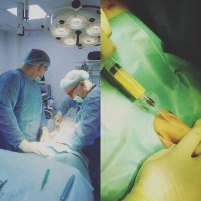 Thickening of the penis is possible with surgery